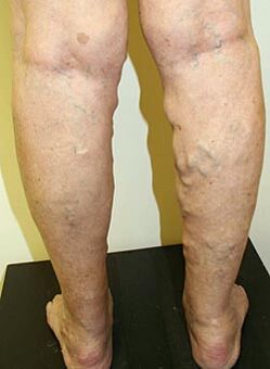 vene varicose sulle gambe