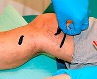 Leeches per vene varicose