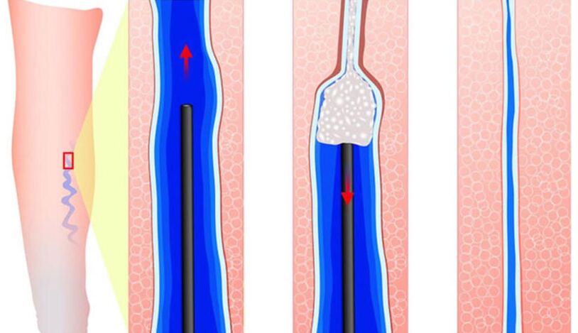 Introduzione dello sclerosante in scleroterapia