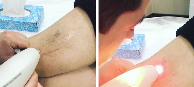 Trattamento laser