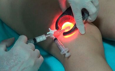 la scleroterapia come modo di trattare le vene varicose sulle gambe